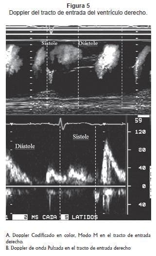 Doppler del ventriculo derecho Doppler del ventriculo derecho