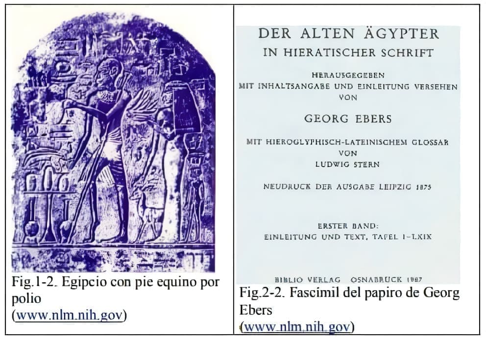 Egipcio con pie equino por polio y Fascímil del papiro de Georg Ebers