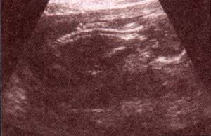 Columna Vertebral Normal 1er trimestre