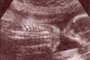 Tórax - cortes tangenciales y frontales