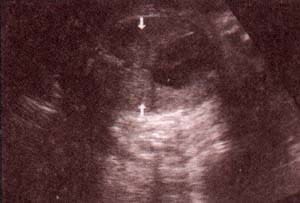 Tórax Normal - corte transversal. 32 semanas