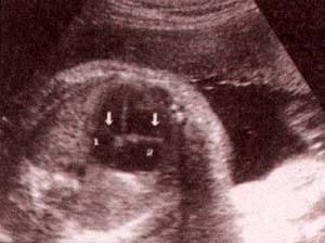 Diagnóstico Prenatal -  válvulas a-v. válvula mitral