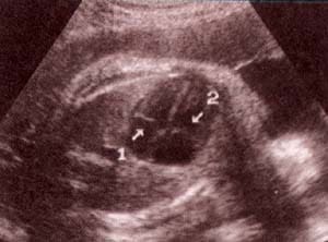 Diagnóstico Prenatal -  válvulas a-v.válvula mitral