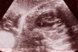 Diagnóstico Prenatal -  ventrículo izquierdo