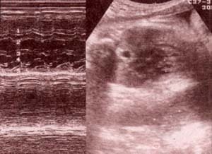 Diagnóstico Prenatal -  a nivel auricular