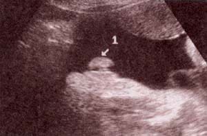 Diagnóstico Prenatal -  genitales externos xx