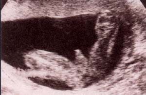 Diagnóstico Prenatal - pene y bolsa escrotal. 17 semanas.