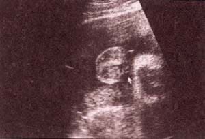 Diagnóstico Prenatal -  bolsa escrotal y su contenido