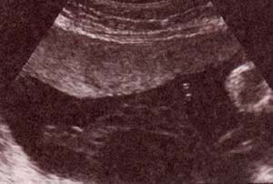Diagnóstico Prenatal -  22 semanas. asa libre.