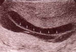 Diagnóstico Prenatal -  membrana interamniótica. Diagnóstico Prenatal - membrana interamniótica.