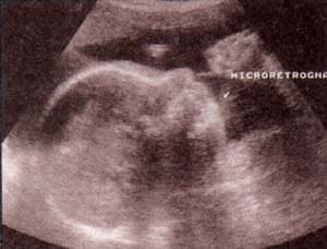 Trimomia 18 (síndrome de edwars)