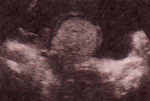 Trisomia 13(síndrome de patau)