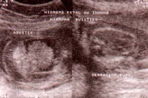 Síndrome de Turner (46 x 0)