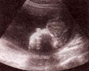 Ausencia de Calota con tejido cerebral expuesto