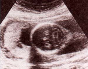 Quiste de plexo coroideo