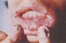 Candidiasis mucocutánea crónica Candidiasis mucocutánea crónica