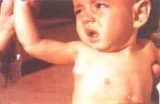 Enfermedad Granulomatosa Crónica Enfermedad Granulomatosa Crónica