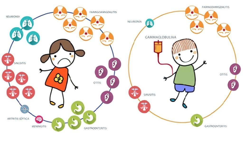 Modulación de la Respuesta Inmune con Gammaglobulina Humana Intravenosa (Igg Iv)