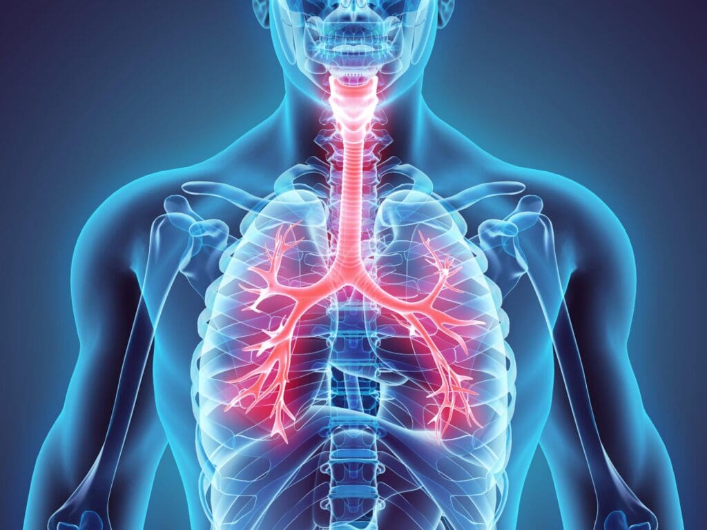Granulomatosis de Wegener