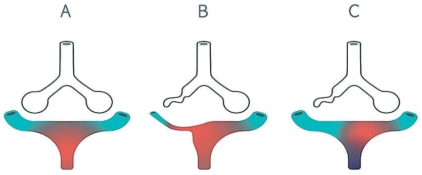 Vasoconstricción pulmonar hipóica