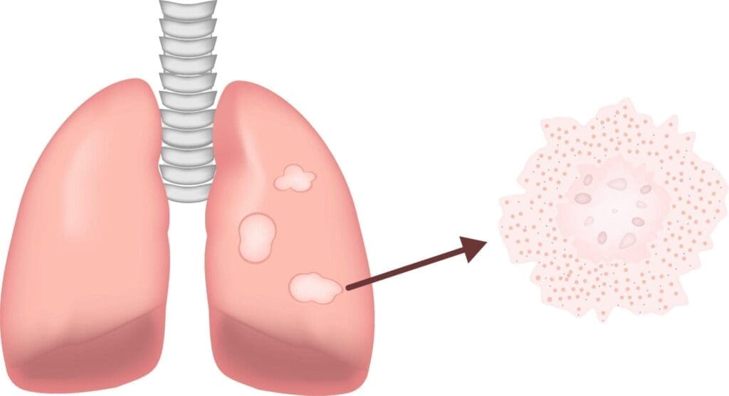 Sarcoidosis