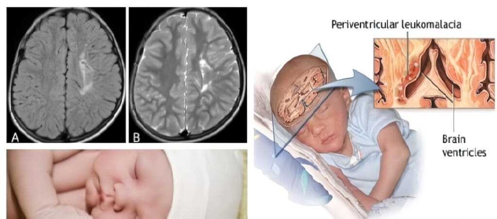 Leucomalacia Periventricular