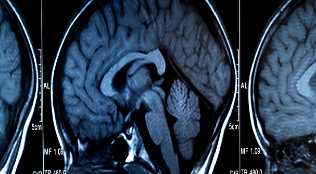Hemorragia Intracraneana