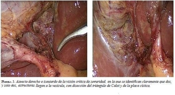 Estructuras que llegan a la vesicula - triangulo de Calot Estructuras que llegan a la vesicula - triangulo de Calot