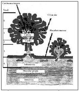 Lesiones polipoides según Haggit Lesiones polipoides según Haggit