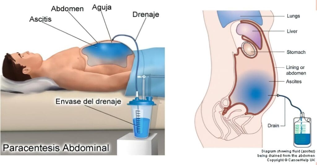 Peritonitis Bacteriana Espontánea