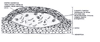 Placa Ateromatosa  Placa Ateromatosa