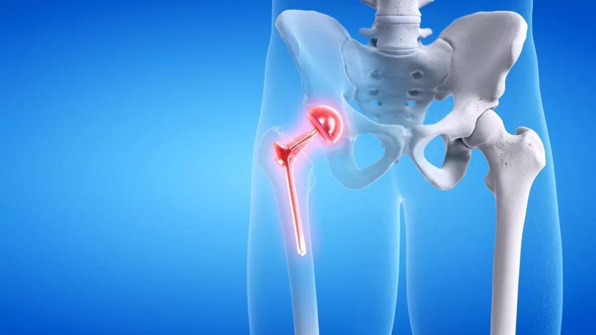artroplastia total de cadera