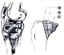 Clasificación de la fractura posteromedial del platillo tibial