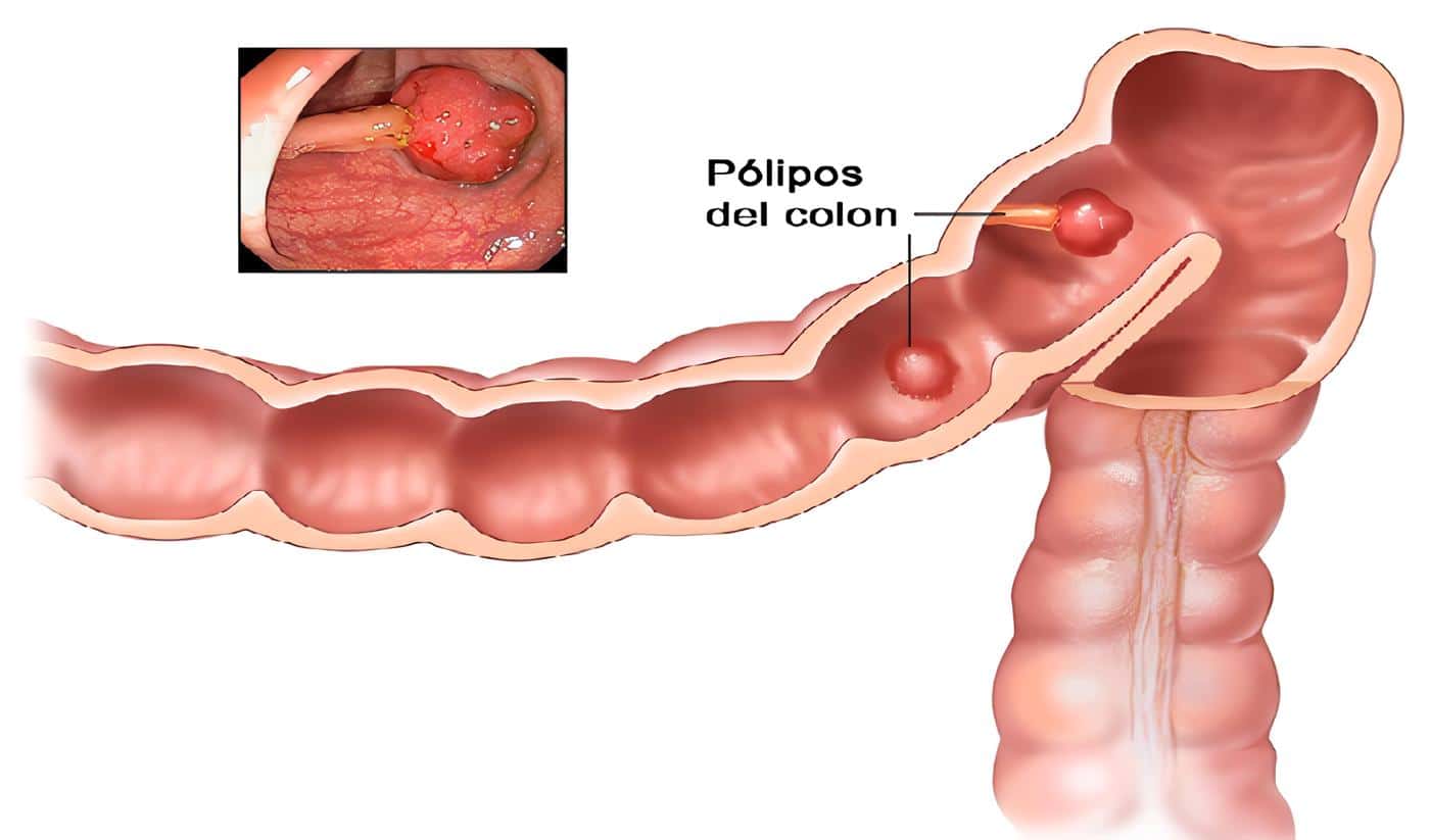 Pólipo Colorrectal Maligno