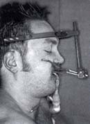 Distractor rígido externo