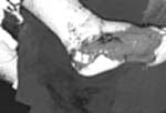 Colgajo plantar medial contralateral, Cirugía Plástica Colgajo plantar medial contralateral, Cirugía Plástica