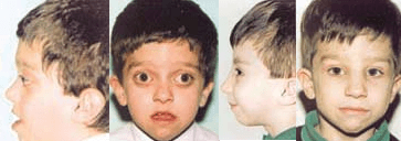 Paciente de 6 años con enfermedad de Crouzon Paciente de 6 años con enfermedad de Crouzon