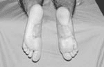 Seis meses postoperatorio, el paciente deambula con calzado normal Seis meses postoperatorio, el paciente deambula con calzado normal