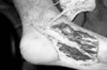 Vista intraoperatoria del colgajo plantar medial contralateral Vista intraoperatoria del colgajo plantar medial contralateral