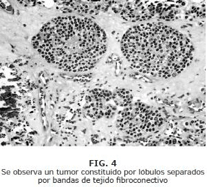 tumor constituido por lóbulos separados tumor constituido por lóbulos separados