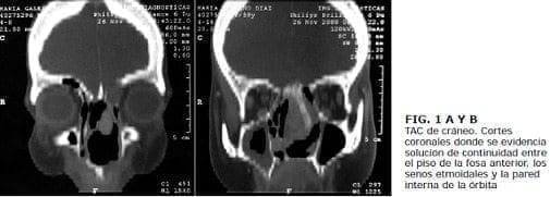 Cráneo. Cortes coronales, Tumor Embrionario Cráneo. Cortes coronales, Tumor Embrionario