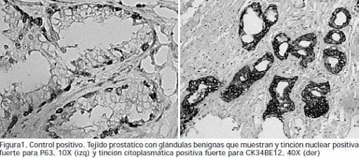 Tejido prostático con glándulas benignas Tejido prostático con glándulas benignas