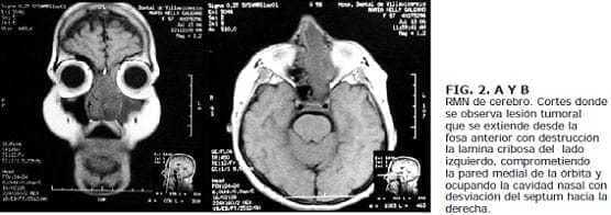 Cortes donde se observa lesión tumor embrionario Cortes donde se observa lesión tumor embrionario