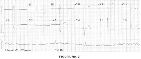 Fibrilación auricular y aleteo auricular Fibrilación auricular y aleteo auricular