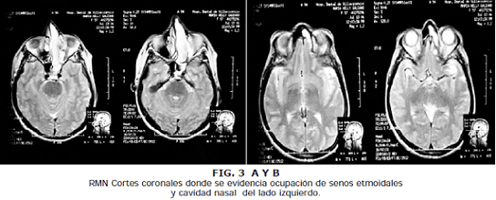Cortes coronales donde se evidencia ocupación de senos etmoidales Cortes coronales donde se evidencia ocupación de senos etmoidales