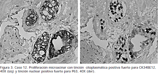 Proliferación microacinar con tinción Proliferación microacinar con tinción