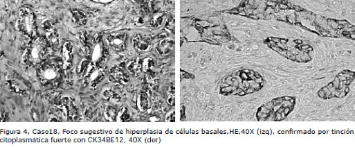 Proliferación microacinar con tinción Proliferación microacinar con tinción