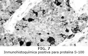 Inmunohistoquímica positiva para proteína S-100-1 Inmunohistoquímica positiva para proteína S-100-1