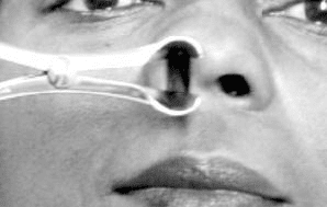 Rinoscopia anterior el espéculo nasal está Rinoscopia anterior el espéculo nasal está