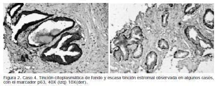Tinción citoplasmática de fondo y escasa tinción estromal, Caso tinción, Biopsias de Próstata Tinción citoplasmática de fondo y escasa tinción estromal, Caso tinción, Biopsias de Próstata